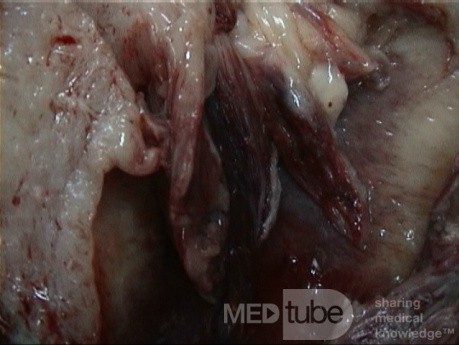 Carcino Sarcoma