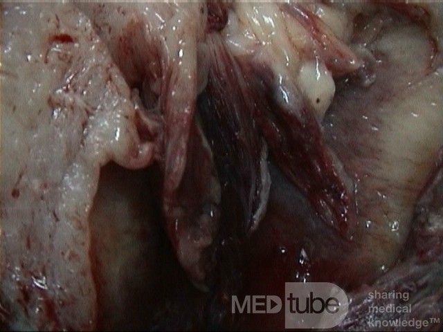 Carcino Sarcoma