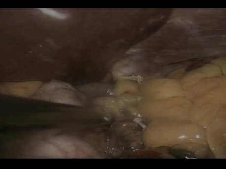 Nissen Fundoplication - Laparoscopic Approach