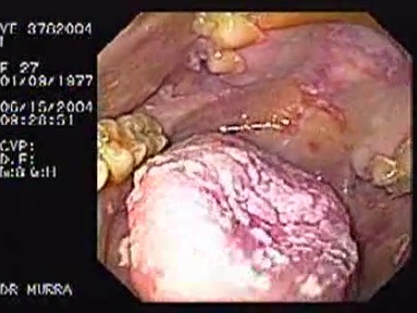 Oropharynge-Esophagic Candidiasis (4 of 5)