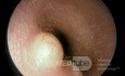 Epidermal Cyst External Ear Canal
