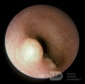 Epidermal Cyst External Ear Canal