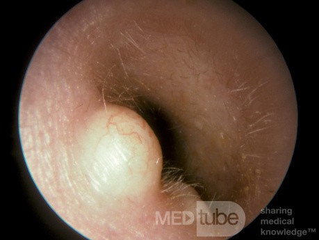 Epidermal Cyst External Ear Canal