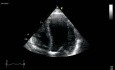 Paradoxical Septum Motion