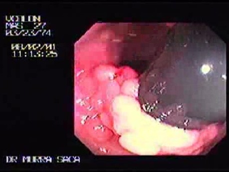 Familial Adenomatous Polyposis of the Colon (18 of 29)