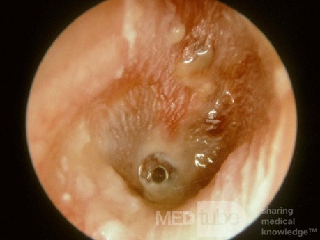 Acute Otitis Media with a Ventilation Tube in Place [AOMT]