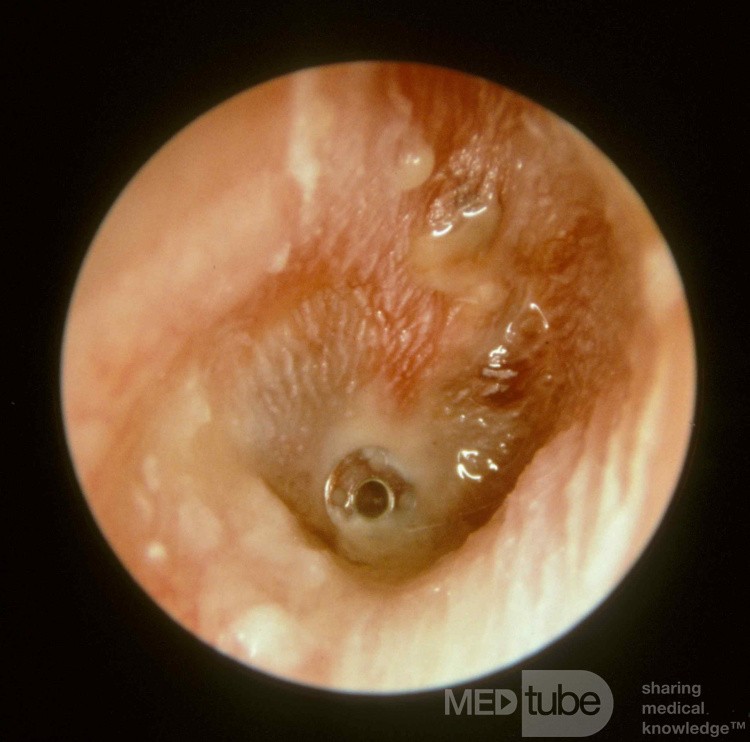 Acute Otitis Media with a Ventilation Tube in Place [AOMT]