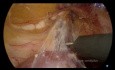 Duodenal Segmental Resection