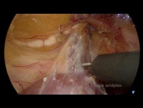 Duodenal Segmental Resection