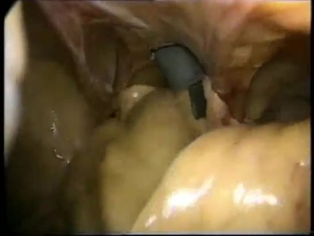 Left Diaphragm - Laparoscopic Reconstruction
