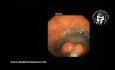 Endoscopic Mucosal Resection (EMR) in the Management of Large Rectal Polyp