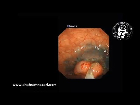 Endoscopic Mucosal Resection (EMR) in the Management of Large Rectal Polyp