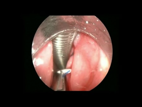 Endoscopic Vocal Cord Lateralization