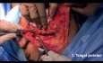 3 Surgical Landmarks for Facial Nerve Identification During Parotidectomy