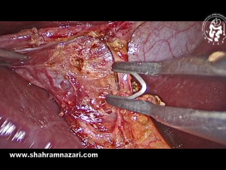 Anatomy-Guided Laparoscopic Cholecystectomy Surgical Landmarks of the Right Hepatic Pedicle