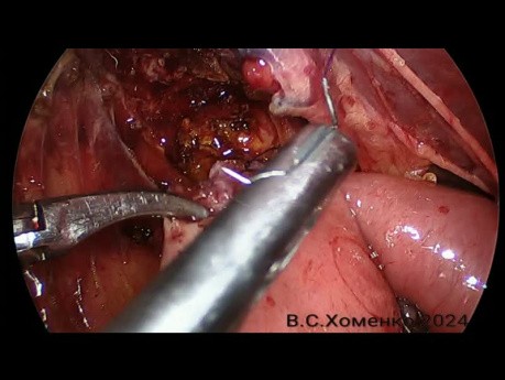 Laparoscopic Hepatojejunostomy