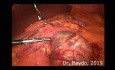 Laparoscopic Removal of Gastric GIST