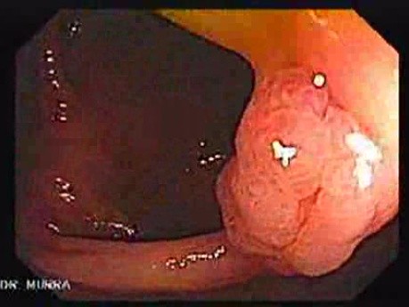 Sessile Tubulovillous Adenoma (1 of 11)