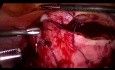 Laparoscopic Myomectomy - How To Do It? Step By Step