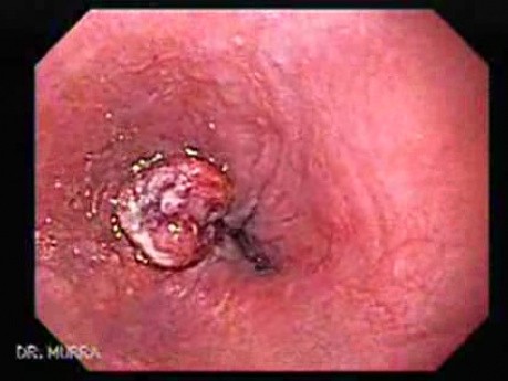 Adenocarcinoma of the Cardia and Fundus with Signet Ring Cells (4 of 5)