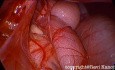 Laparoscopic Overview of Diaphragmatic Defects