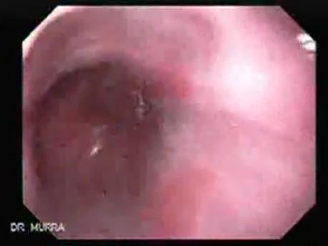 Barrett's Esophagus of long segment (3 of 11)