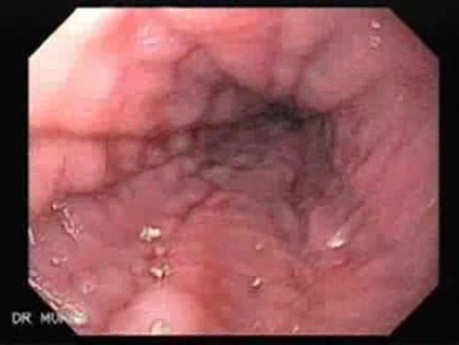 Leather Bottle Stomach - Endoscopy (1 of 9)