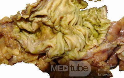 Ascending Colon Cancer (8 of 9)