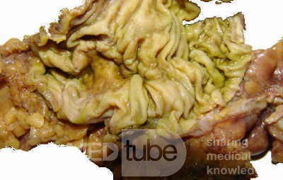 Ascending Colon Cancer (8 of 9)