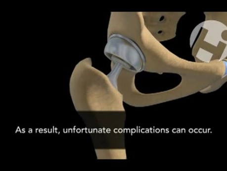 Complications From Total Hip Replacement