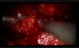 Radical Prostatectomy with Neuro-Vascular Preservation by Eric Barret