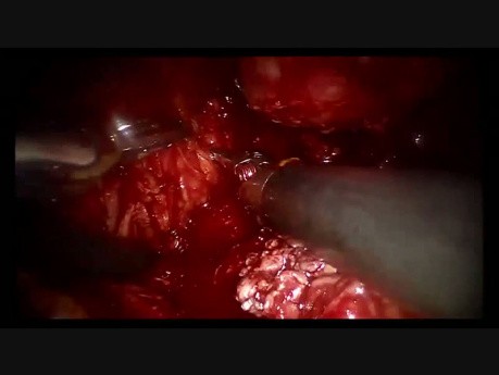 Radical Prostatectomy with Neuro-Vascular Preservation by Eric Barret