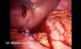 Laparoscopic ALPPS Right Trissegmentectomy