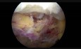 2 CLA Lt Stenosis Disectomy