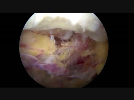 2 CLA Lt Stenosis Disectomy