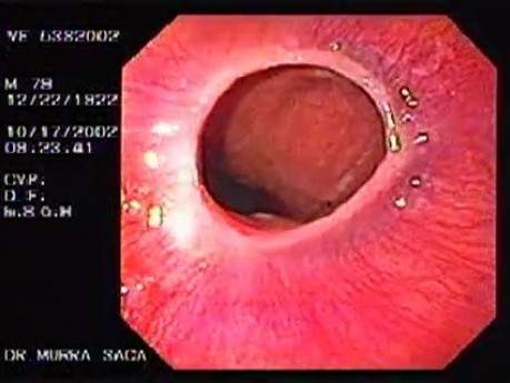 Esophagus Schatzki Ring (1 of 3)