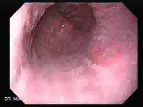 Barrett's Esophagus of long segment (4 of 11)