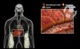 Hyperlipidemia