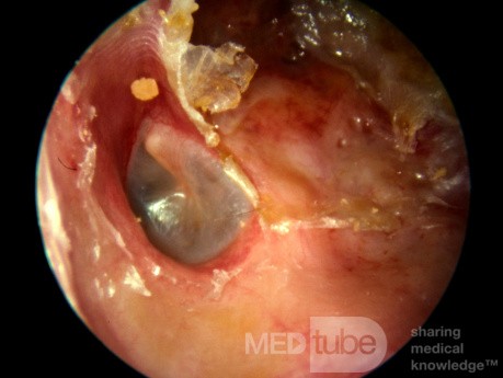 Automastoidectomy from Keratosis Obturans