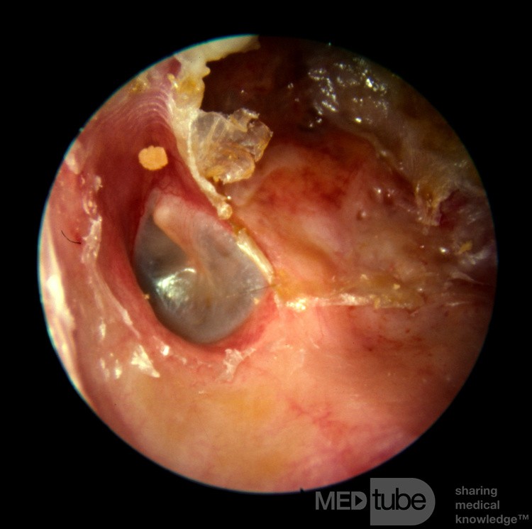 Automastoidectomy from Keratosis Obturans