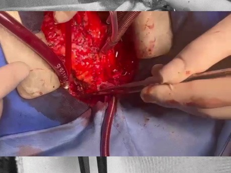 Pulmonary Homograft from DCD patient for RVOT Reconstruction 