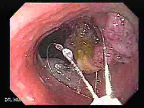 Colonoscopic Polypectomy (15 of 18)