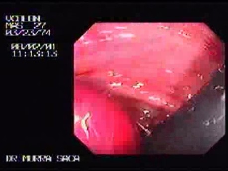 Familial Adenomatous Polyposis of the Colon (16 of 29)