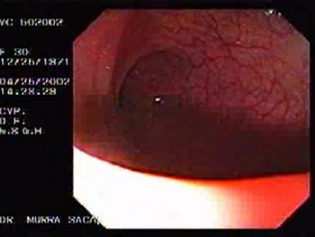Full Colonoscopy (4 of 4)
