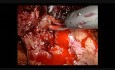 Retroperitoneoscopic Right Partial Nephrectomy