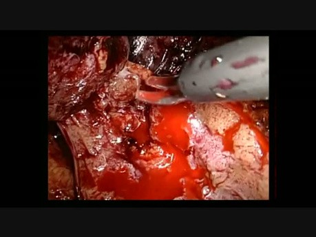 Retroperitoneoscopic Right Partial Nephrectomy