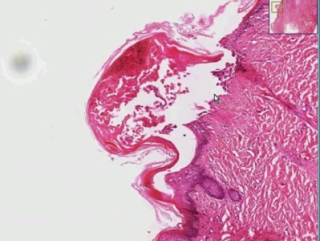 Varicella (chicken pox)