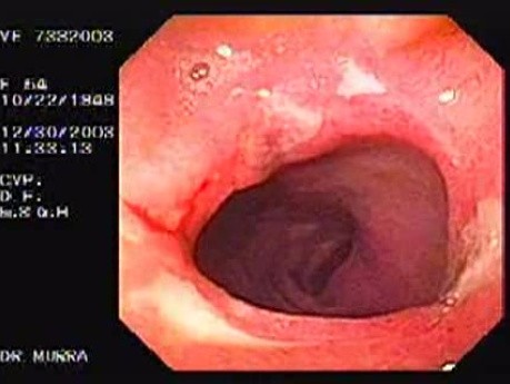 Multiple Ulcers of the Duodenal Bulb (1 of 2)