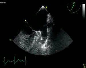 Thrombus In Left Atrial Appendage