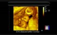 3D 4D Ultrasound Normal 13 wk Fetus
